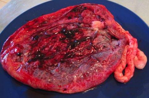 placenta humana